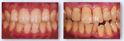 ホワイトニング